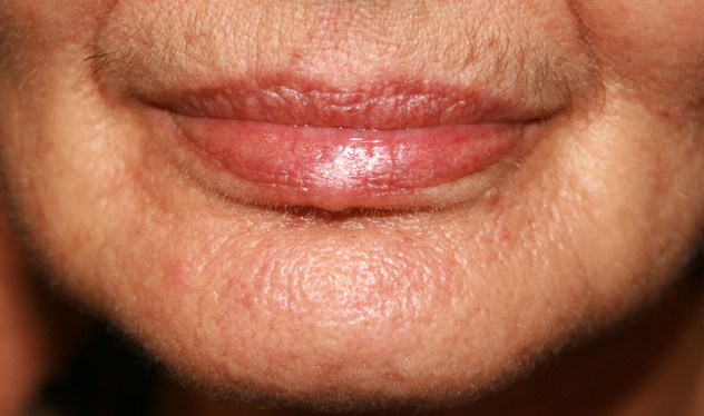 Lips. Silicone. Nasolabial folds. Wrinkles around the mouth